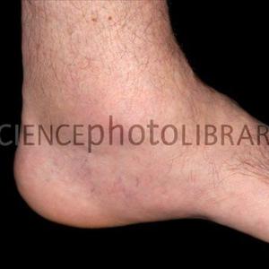 Gout And Lemons - Psoriatic Arthritis Symptoms