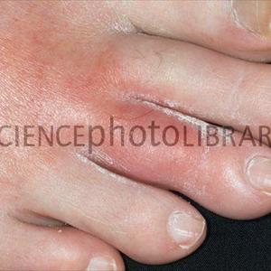 Gout In Women - Gout Natural Remedy