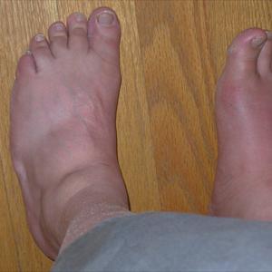 Gout And Alcohol - Learn How To Stop Gout Pain And Inflammation