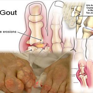 Hip Joint Gout - Natural Alternatives For Gout Relief