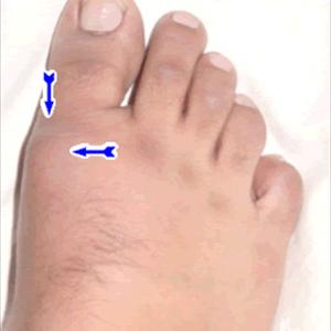 Electric Treatment Gout - Arthritis Pain