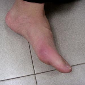 Gout Flare - Natural Alternatives For Gout Relief