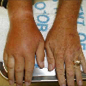 Can Gout Spread - Gout Treatment Medicines Or Drugs And Their Side Effects