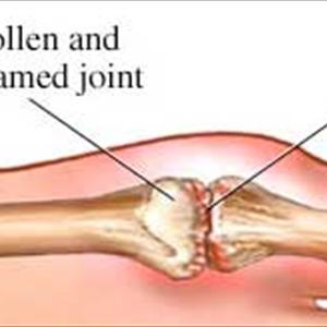 Gout On Foot - A Few Important And Useful Facts On Colchicine