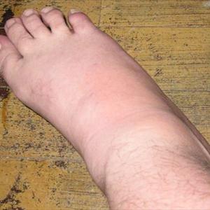 Gout Food List - Cherries - Mother Nature