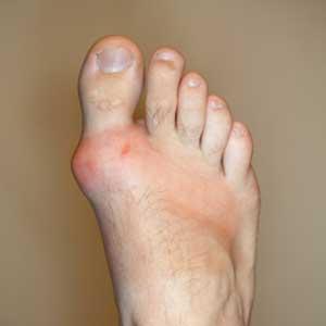 Gout Treatment Site - Want Gout Relief - 4 Tips To Eliminate Excruciating Gout Pain