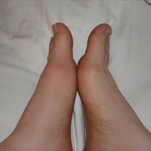 Pain In Joints - Gout Relief, Ways To Get Relief From Gout