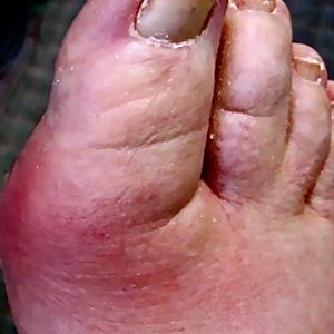 Alcohol And Gout - Learn How To Stop Gout Pain And Inflammation