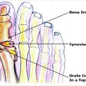 Honey And Gout - The Abc Nutrients For Bone Health