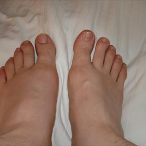 Sorse Of Colchicine - Recurring Gout And How To Prevent It