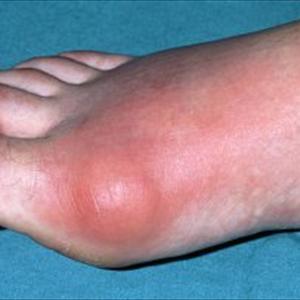 Image Of Gout - A Gout Diet- Foods You Might Take In