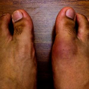 The Gout Diet - The Disease Of Kings Becoming More Common In The U.S.