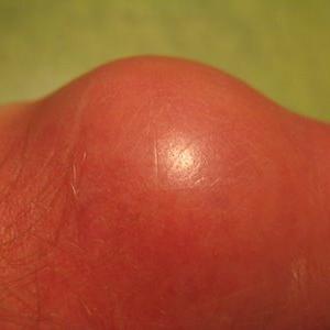 Goutcure Review - Tips On Preventing Gout