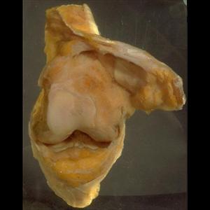 Knee Gout - The Lost Secret Of Ankle Gout