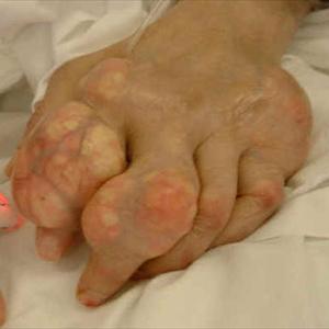 Gout Debilitating - Gout - Alcohol Consumption And Gout Attacks