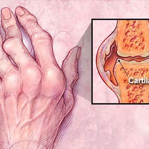 Information On Gout - Tens And Transcutaneous Electrical Nerve Muscle Stimulation Machine