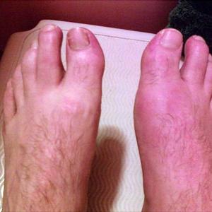 Turf Toe Gout - Knockout Knee Pain