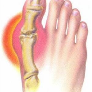 Gouty Tophi - How To Cure Gout Tips On How To Cure Gout